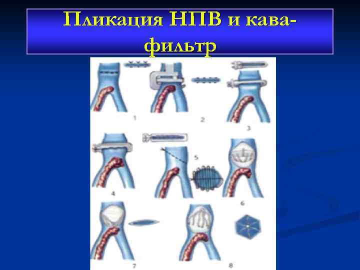 Пликация НПВ и кавафильтр 