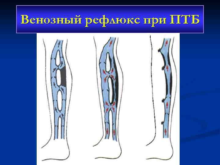 Венозный рефлюкс при ПТБ 