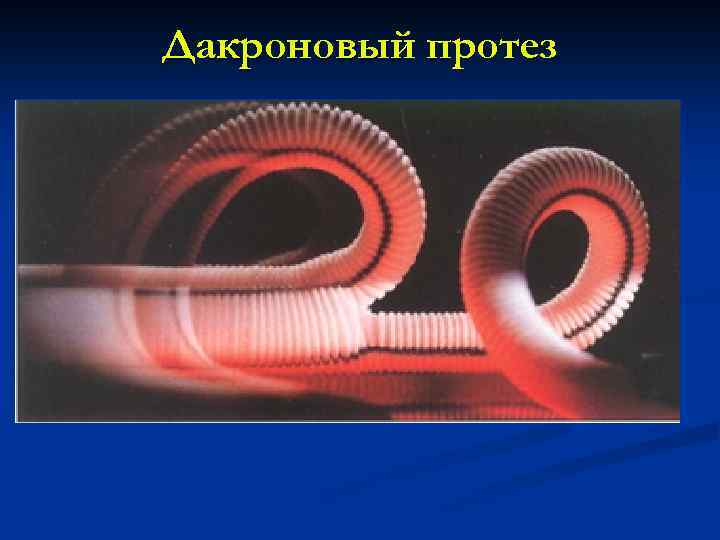 Дакроновый протез 