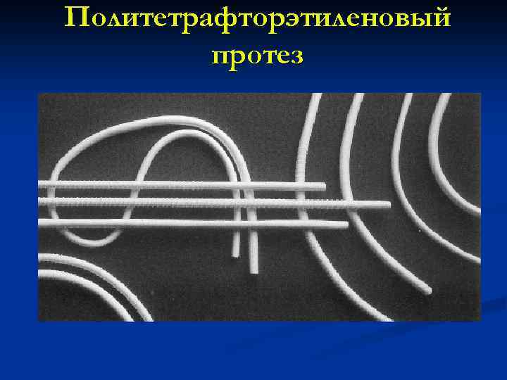 Политетрафторэтиленовый протез 