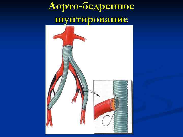 Аорто-бедренное шунтирование 