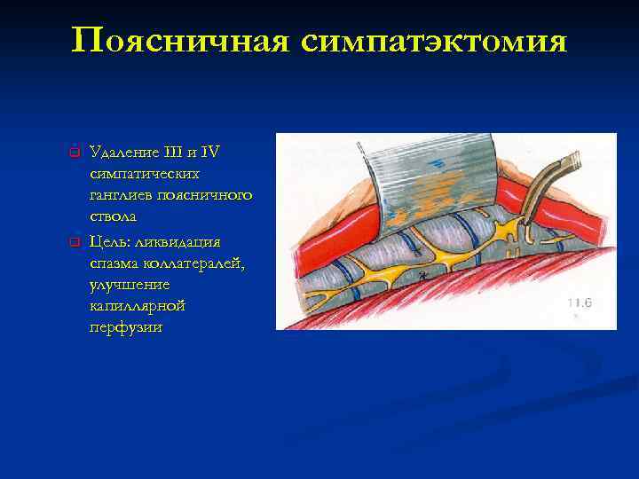Поясничная симпатэктомия q q Удаление III и IV симпатических ганглиев поясничного ствола Цель: ликвидация