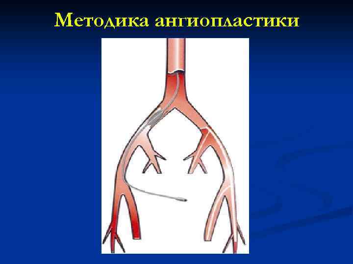 Методика ангиопластики 