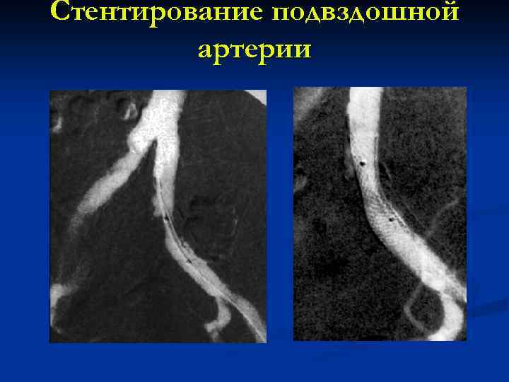 Стентирование подвздошной артерии 