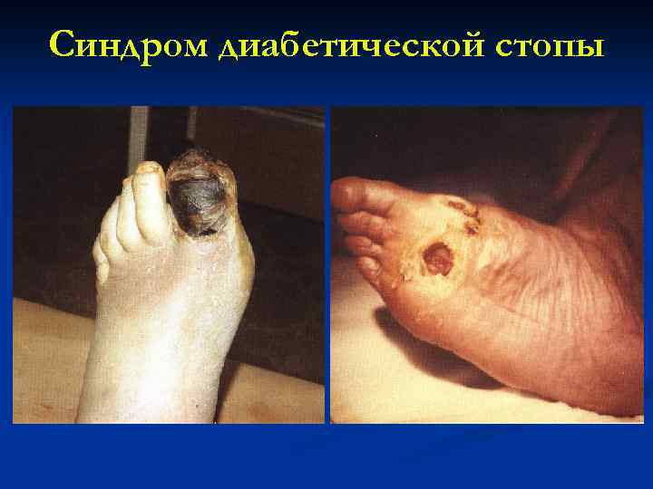 Синдром диабетической стопы 