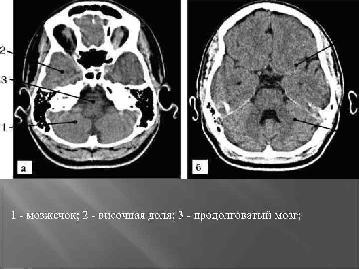 1 - мозжечок; 2 - височная доля; 3 - продолговатый мозг; 