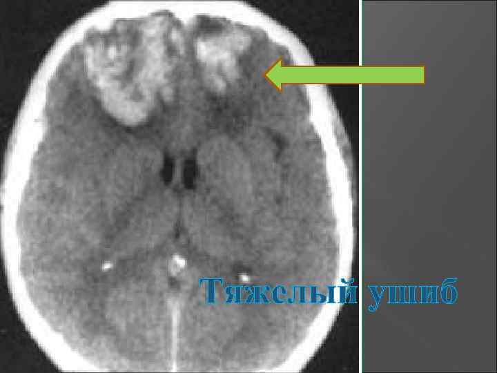Тяжелый ушиб 