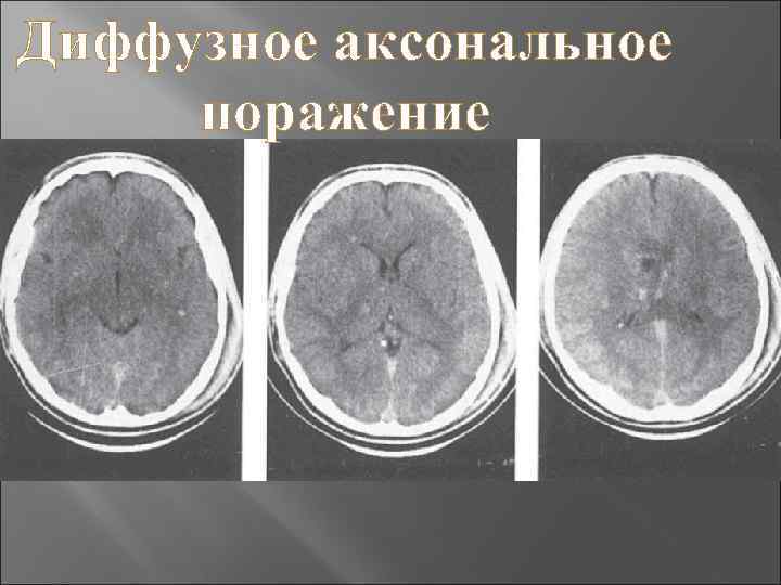 Диффузное аксональное поражение 
