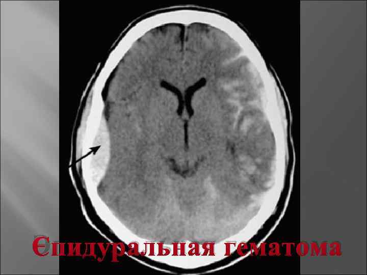 Эпидуральная гематома 