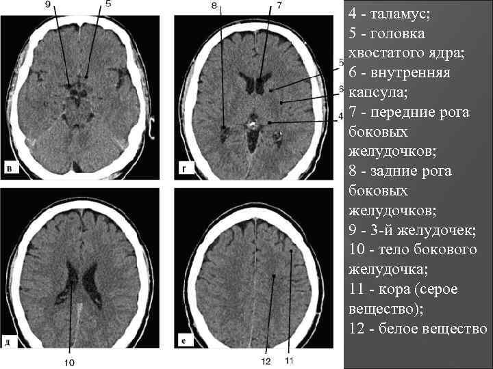 4 - таламус; 5 - головка хвостатого ядра; 6 - внутренняя капсула; 7 -