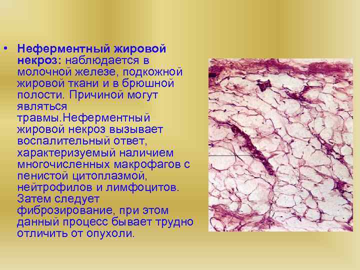  • Неферментный жировой некроз: наблюдается в молочной железе, подкожной жировой ткани и в