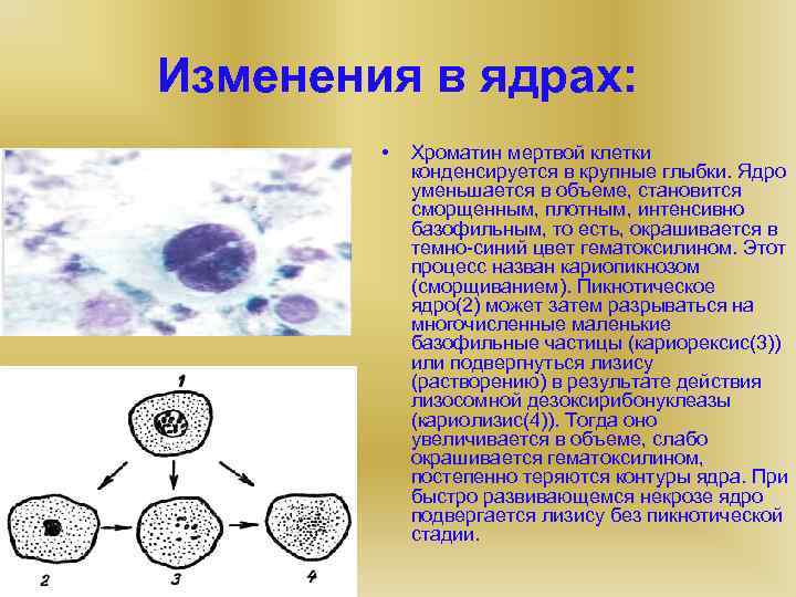 Клетки с гиперхромными ядрами. Кариопикноз кариорексис кариолизис. Изменения ядра клетки. Процессы развивающиеся в ядре клетки при некрозе. Изменения в ядрах.