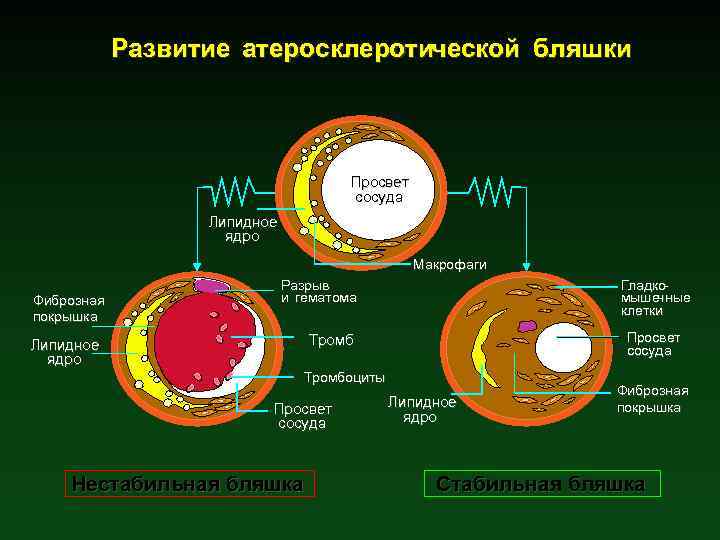 Pазвитие атеросклеротической бляшки Просвет сосуда Липидное ядро Макрофаги Фиброзная покрышка Разрыв и гематома Гладкомышечные