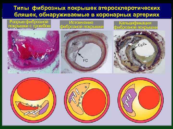 Типы фиброзных покрышек атеросклеротических бляшек, обнаруживаемые в коронарных артериях Разрыв фиброзной покрышки с тромбом