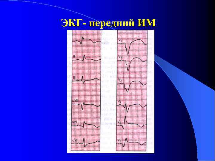 ЭКГ- передний ИМ 