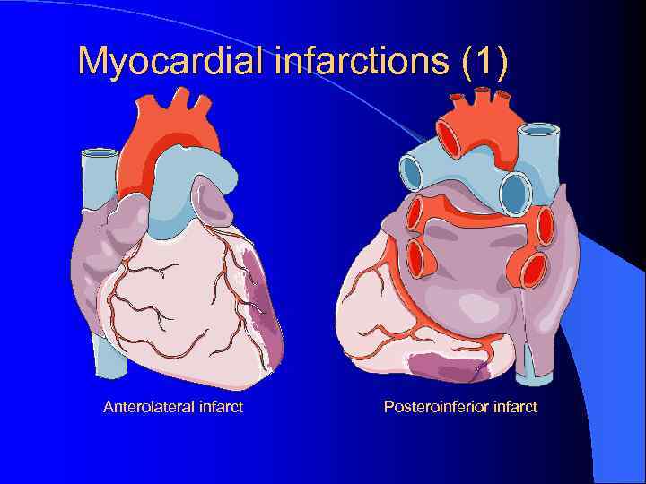 Myocardial infarctions (1) Anterolateral infarct Posteroinferior infarct 