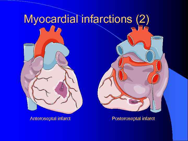 Myocardial infarctions (2) Anteroseptal infarct Posteroseptal infarct 