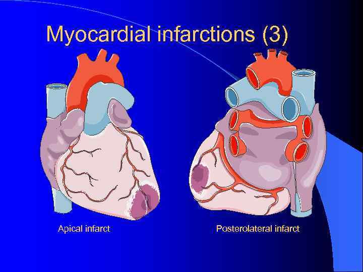 Myocardial infarctions (3) Apical infarct Posterolateral infarct 