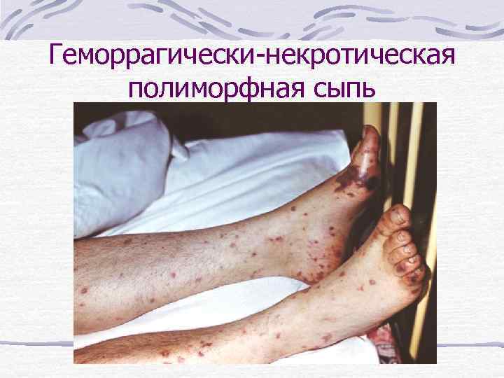 Геморрагически-некротическая полиморфная сыпь 