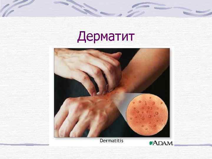 Дерматит 