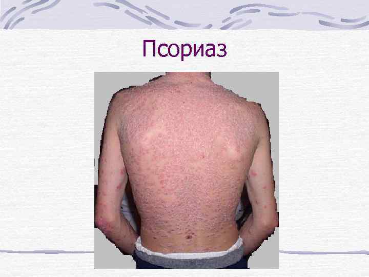 Псориаз 