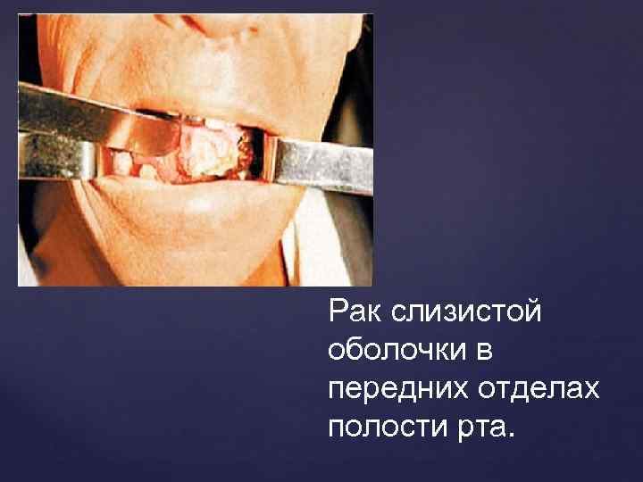 Рак слизистой оболочки в передних отделах полости рта. 