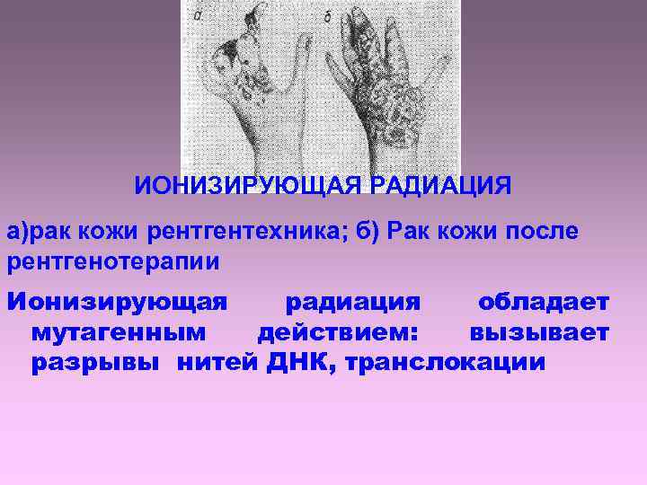 ИОНИЗИРУЮЩАЯ РАДИАЦИЯ а)рак кожи рентгентехника; б) Рак кожи после рентгенотерапии Ионизирующая радиация обладает мутагенным