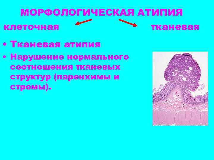 МОРФОЛОГИЧЕСКАЯ АТИПИЯ клеточная тканевая • Тканевая атипия • Нарушение нормального соотношения тканевых структур (паренхимы