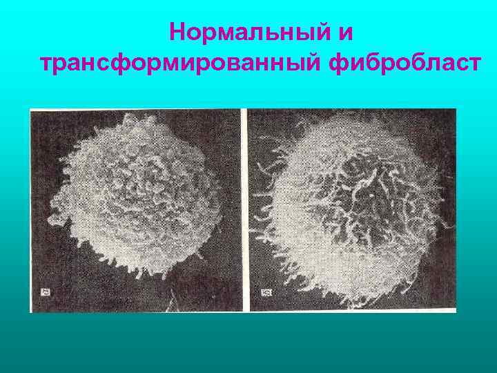 Нормальный и трансформированный фибробласт 