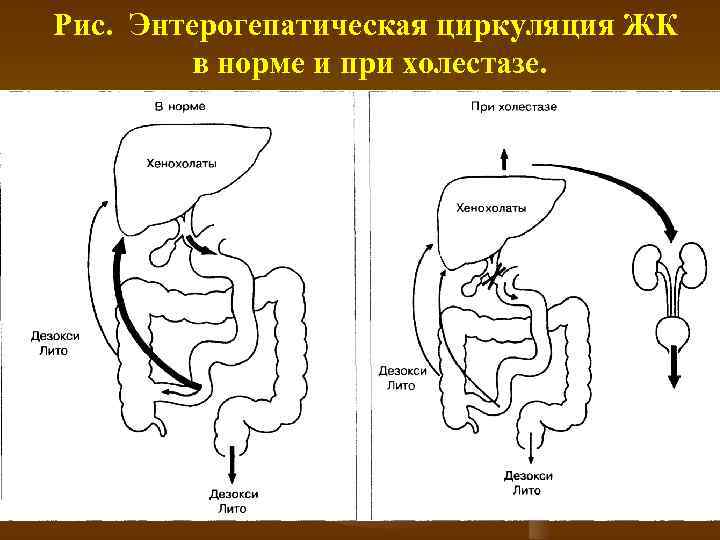 Рис. Энтерогепатическая циркуляция ЖК в норме и при холестазе. 