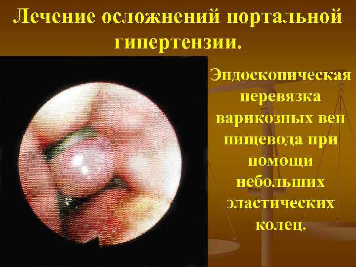 Лечение осложнений портальной гипертензии. Эндоскопическая перевязка варикозных вен пищевода при помощи небольших эластических колец.