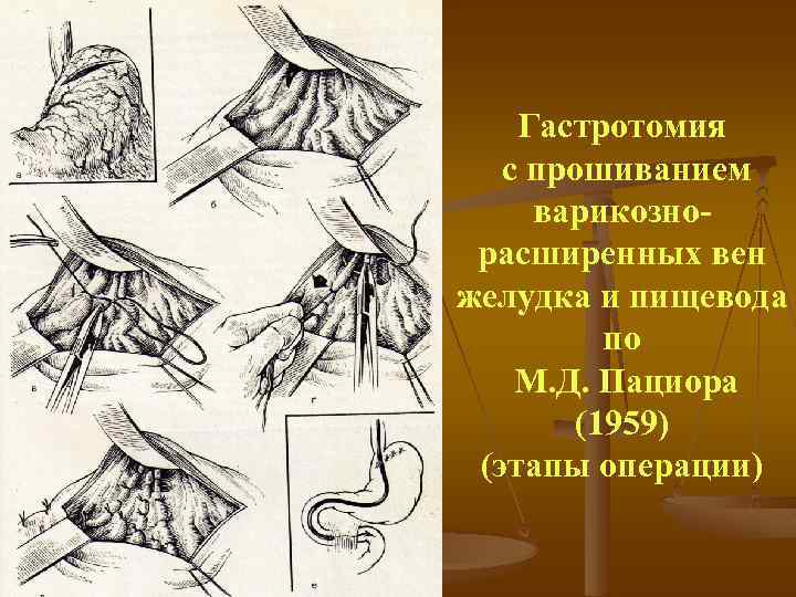 Гастротомия с прошиванием варикозно расширенных вен желудка и пищевода по М. Д. Пациора (1959)