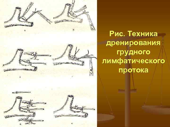 Рис. Техника дренирования грудного лимфатического протока 
