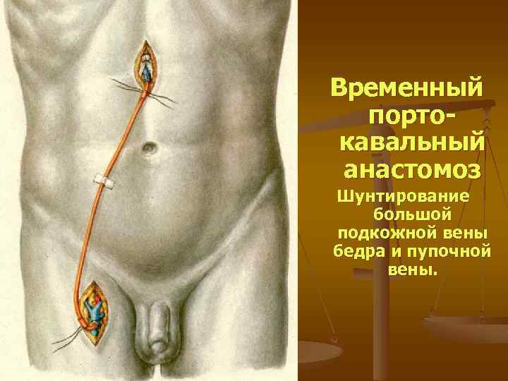 Временный портокавальный анастомоз Шунтирование большой подкожной вены бедра и пупочной вены. 