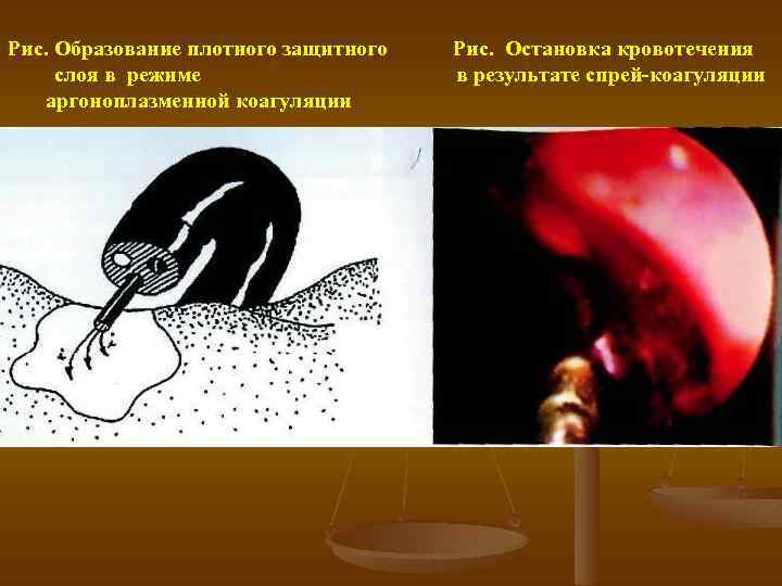 Рис. Образование плотного защитного слоя в режиме аргоноплазменной коагуляции Рис. Остановка кровотечения в результате