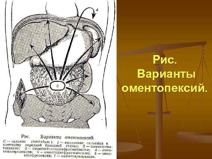 Рис. Варианты оментопексий. 