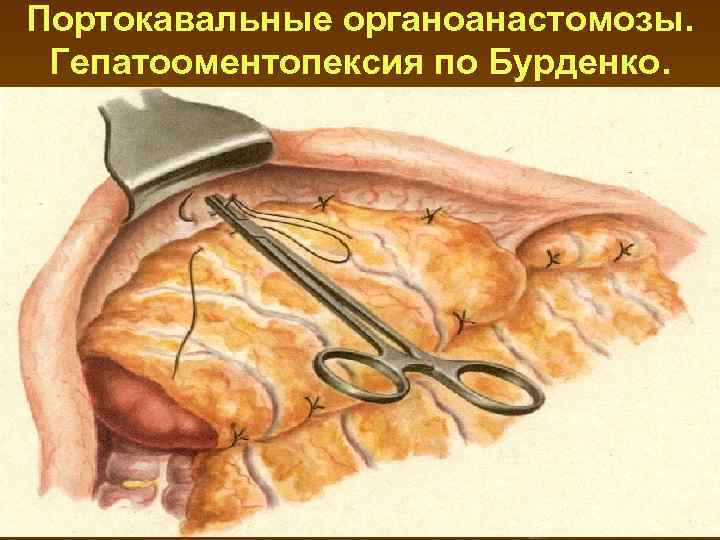 Портокавальные органоанастомозы. Гепатооментопексия по Бурденко. 