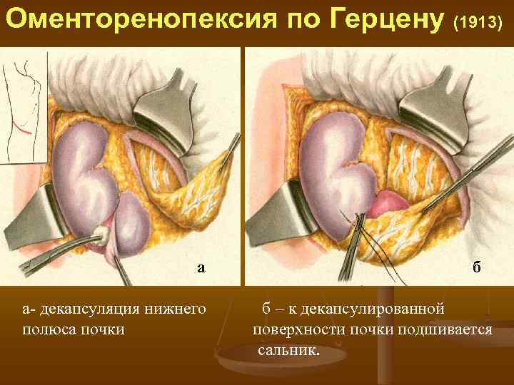 Оменторенопексия по Герцену (1913) а а декапсуляция нижнего полюса почки б б – к