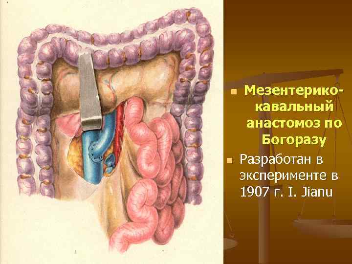 n n Мезентерикокавальный анастомоз по Богоразу Разработан в эксперименте в 1907 г. I. Jianu