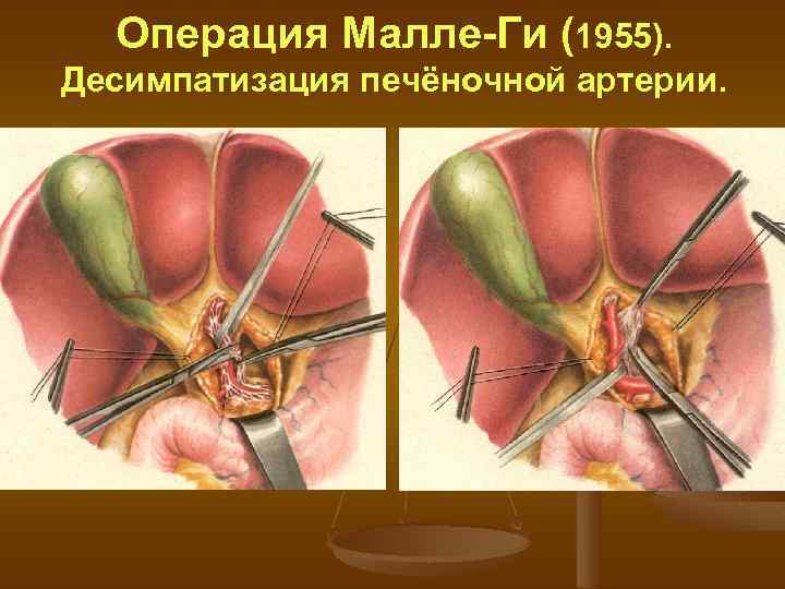 Операция Малле-Ги (1955). Десимпатизация печёночной артерии. 