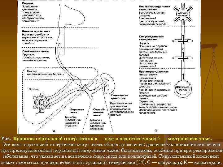 Рис. Причины портальной гипертензии: а — под и надпеченочные; б — внутрипеченочные. Эти виды