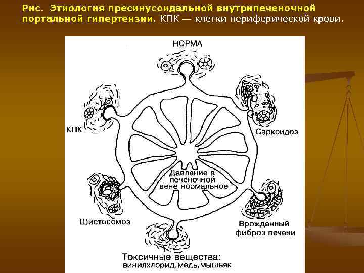 Рис. Этиология пресинусоидальной внутрипеченочной портальной гипертензии. КПК — клетки периферической крови. 