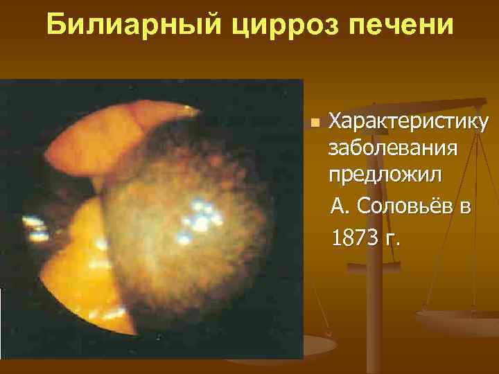 Билиарный цирроз печени n Характеристику заболевания предложил А. Соловьёв в 1873 г. 