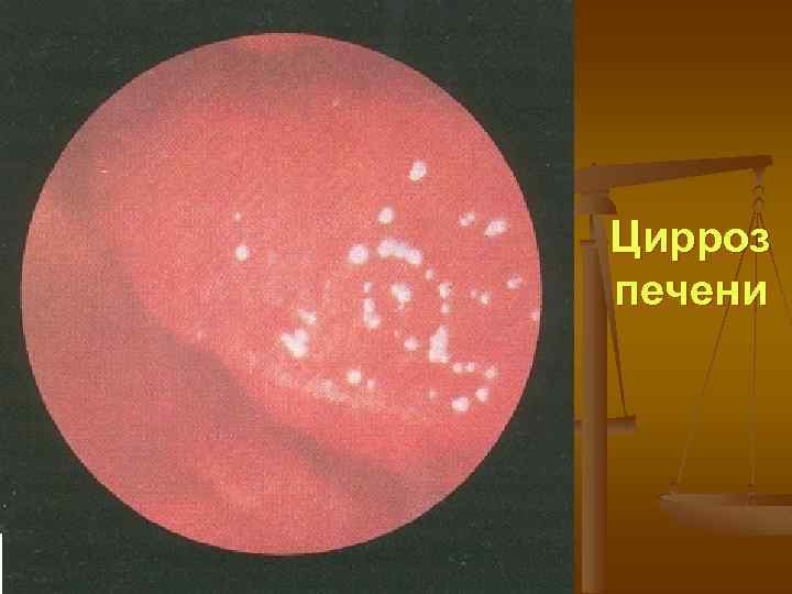 Цирроз печени 