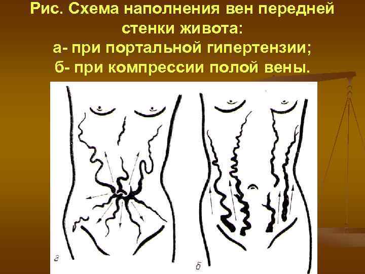 Рис. Схема наполнения вен передней стенки живота: а- при портальной гипертензии; б- при компрессии