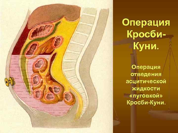 Операция Кросби. Куни. Операция отведения асцитической жидкости «пуговкой» Кросби-Куни. 