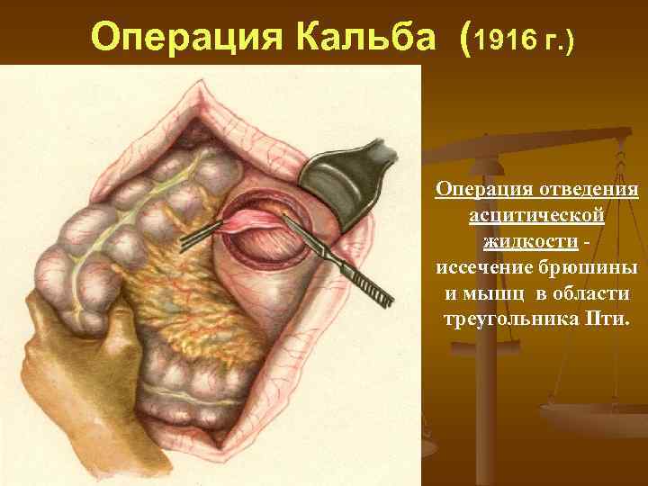 Операция Кальба (1916 г. ) Операция отведения асцитической жидкости иссечение брюшины и мышц в
