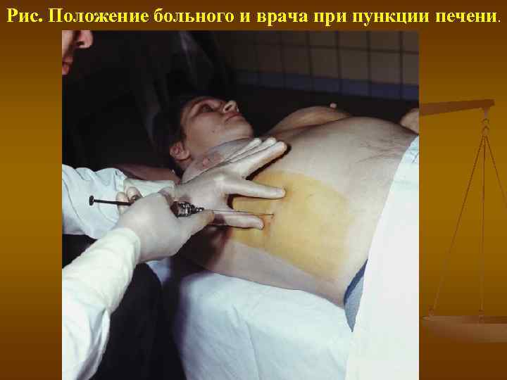 Рис. Положение больного и врача при пункции печени. 