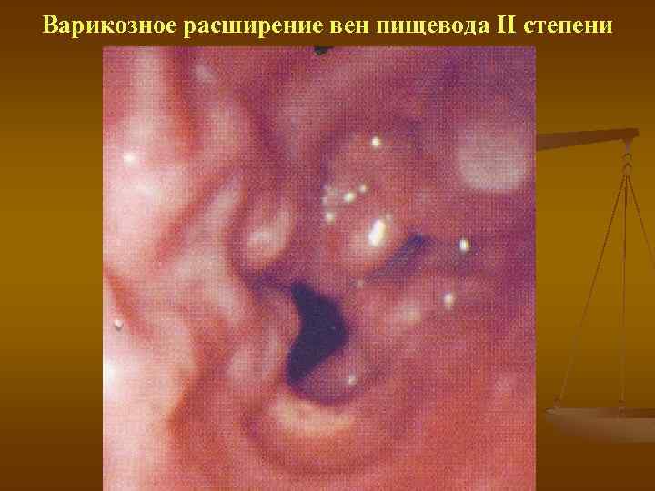 Варикозное расширение вен пищевода II степени 