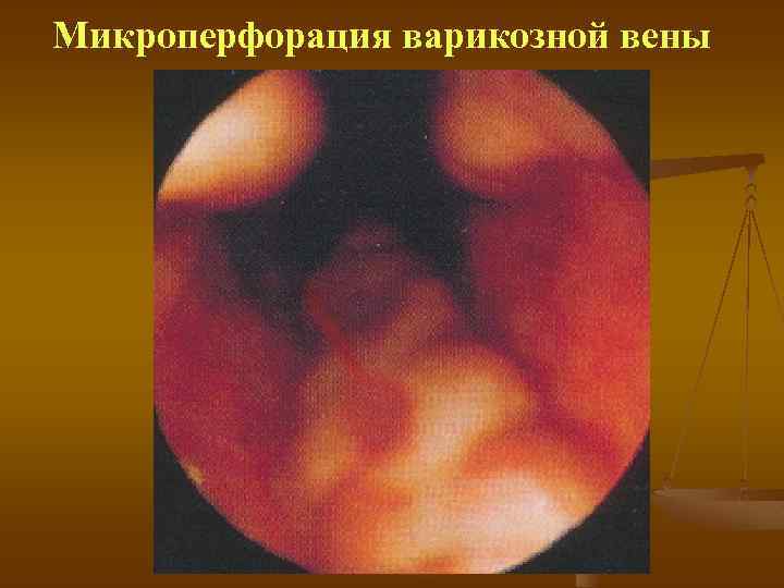 Микроперфорация варикозной вены 
